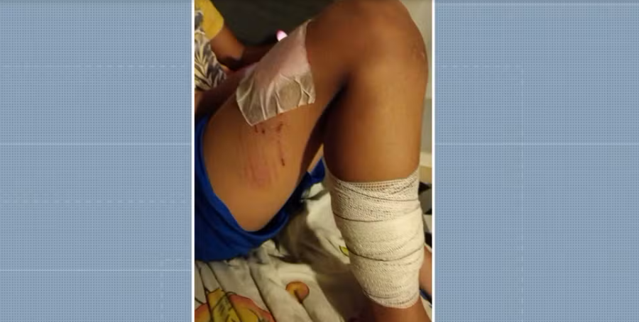 Crianças ficam feridas após ataque de pitbull em condomínio de Monte Mor (SP)
