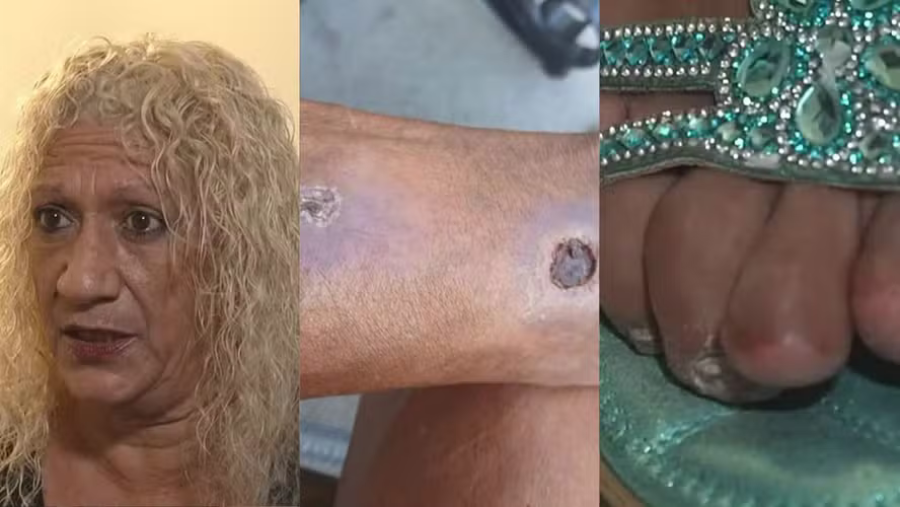 Mulher perde dedos após picadas de aranha e processa condomínio na Flórida